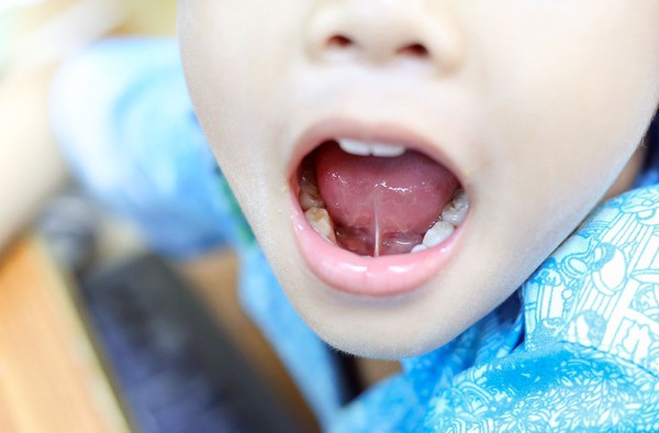 Nguyên nhân gây ra dính thắng lưỡi trẻ em