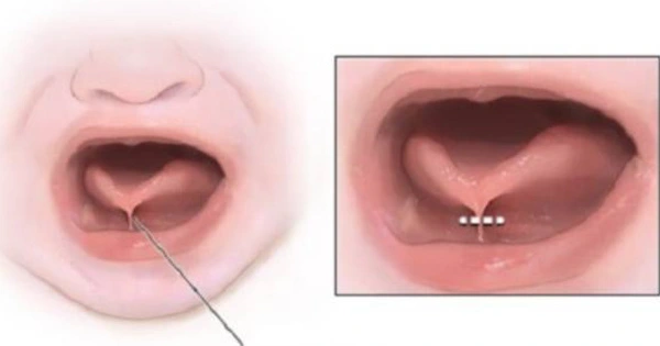 Dấu hiệu nhận biết sớm tình trạng dính thắng lưỡi trẻ em