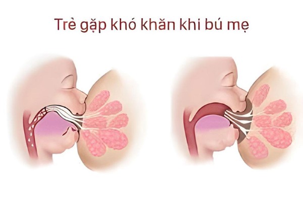 Dính thắng lưỡi làm trẻ khó khăn trong việc bú mẹ