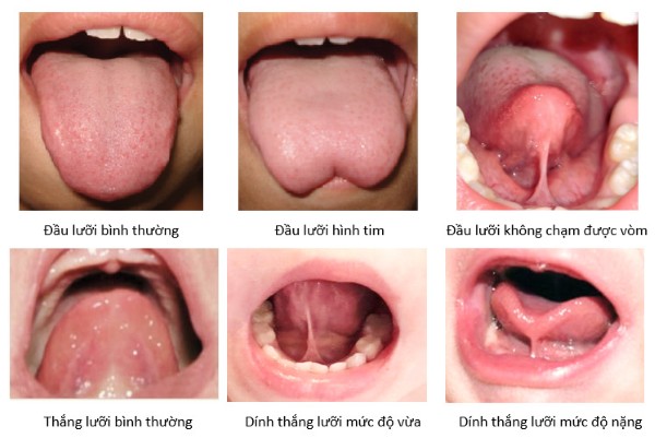 Lời khuyên quan trọng dành cho phụ huynh nhận biết tình trạng dính thắng lưỡi trẻ em