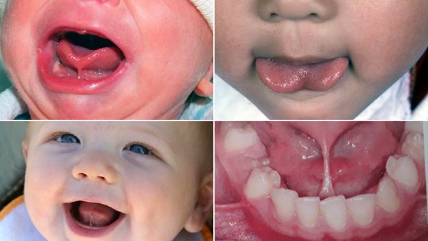 Các câu hỏi thường gặp về dính thắng lưỡi trẻ em