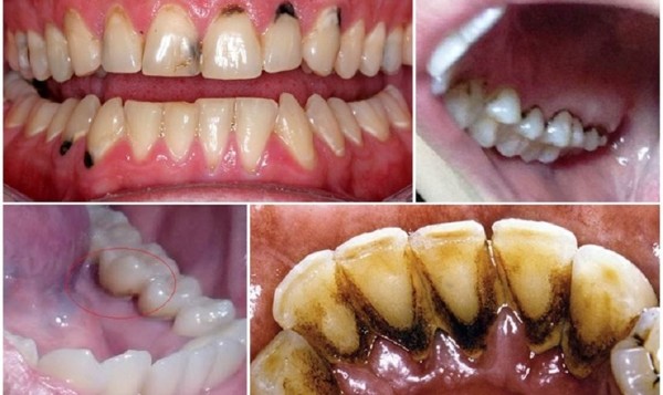 Những nguyên nhân chính dẫn đến tình trạng hình thành mảng bám đen trên răng