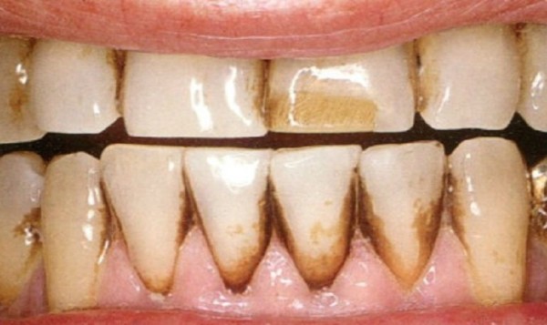 Các câu hỏi thường gặp về mảng bám đen trên răng
