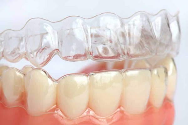 Nẹp răng trong suốt là một phương pháp chỉnh nha tiên tiến thẩm mỹ cao