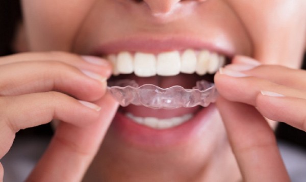 Những hạn chế khi sử dụng nẹp răng trong suốt