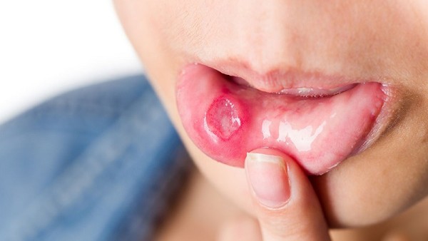 Nổi đẹn là gì?