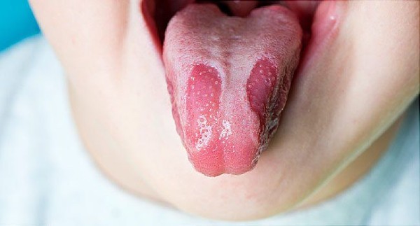Đẹn do Candida thường gặp ở trẻ sơ sinh và người lớn