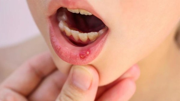 Nguyên nhân dẫn đến tình trạng nổi đẹn chủ yếu từ nhiều yếu tố khác nhau