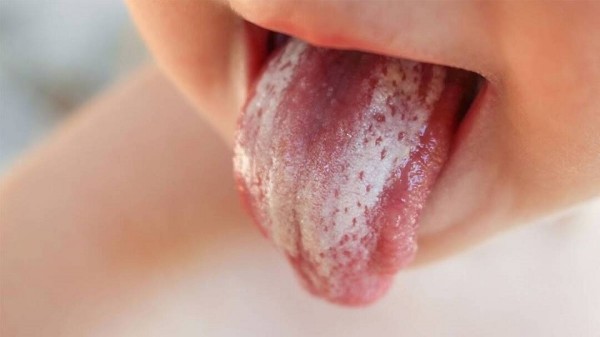 Triệu chứng của nổi đẹn có thể rất đa dạng và khác nhau