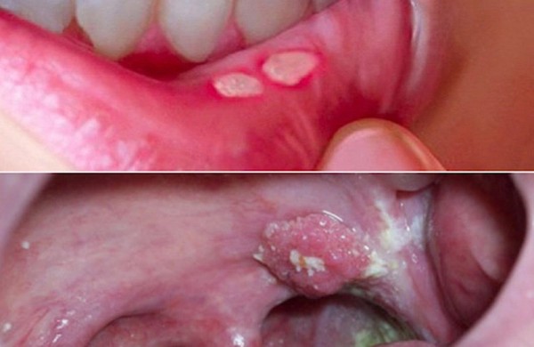 Phân biệt nổi đẹn với các bệnh đường miệng khác