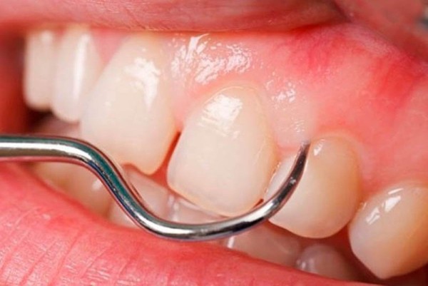 Nướu răng là gì?