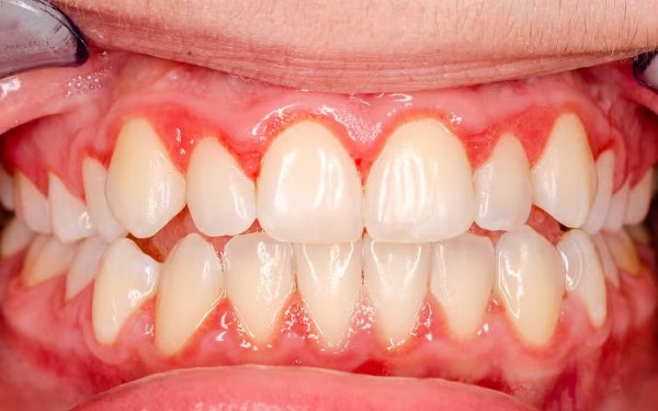 Tình trạng viêm nướu răng