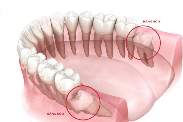 Răng số 8 hay còn gọi là răng khôn