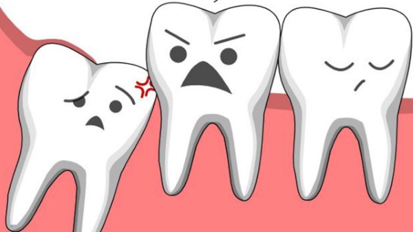 Răng số 8 mọc lệch 