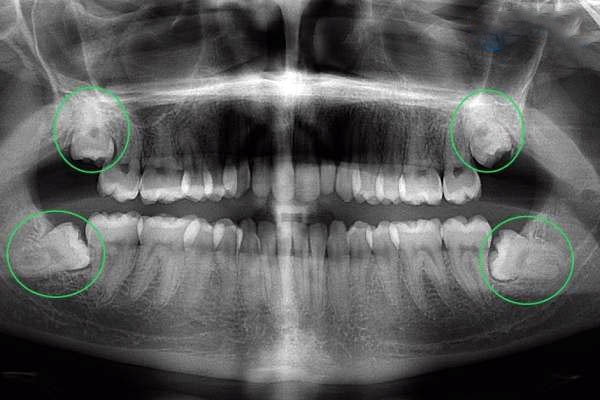 Quy trình chẩn đoán tình trạng răng số 8 mọc lệch