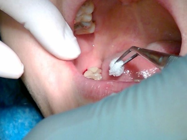 Hướng dẫn xử lý và điều trị khi răng số 8 mọc lệch