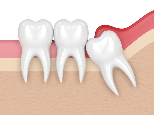 Một số câu hỏi thường gặp về răng số 8 mọc lệch