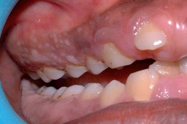 U men răng là một dạng khối u phát triển từ tế bào men răng