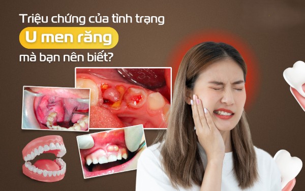 Triệu chứng và dấu hiệu nhận biết u men răng
