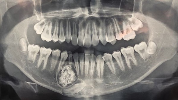 Ảnh chụp CT chẩn đoán u men răng 