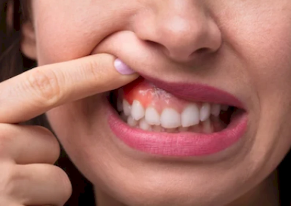 U men răng có thể gây ra nhiều thay đổi về thẩm mỹ và chức năng của hàm mặt