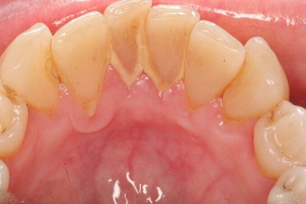 Cao răng được hình thành từ quá trình tích tụ mảng bám trên răng