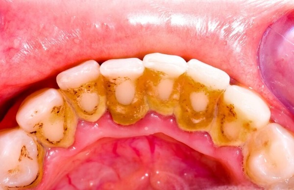 Dấu hiệu nhận biết nên đi lấy cao răng