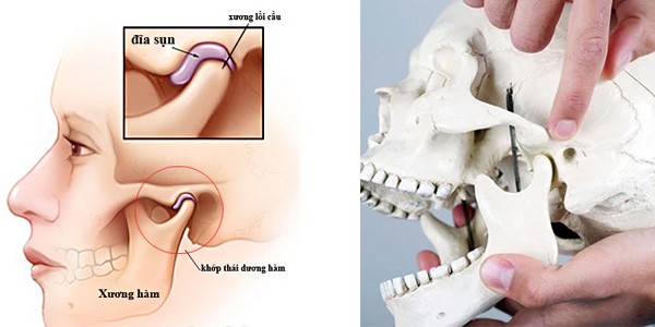 Viêm khớp thái dương hàm là nguyên nhân chính gây bị đau quai hàm gần tai bên phải