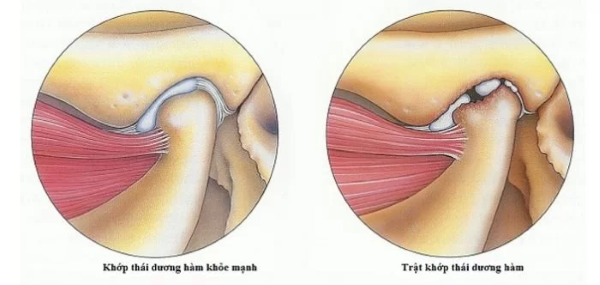 Sái quai hàm cũng là một nguyên nhân gây bị đau quai hàm gần tai bên phải