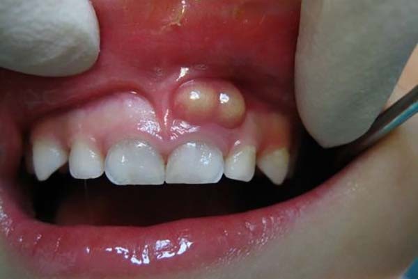 Các bệnh về viêm nhiễm vùng quanh răng