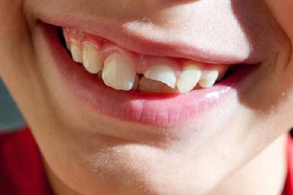 Các bệnh về răng do chấn thương hoặc yếu tố bên ngoài