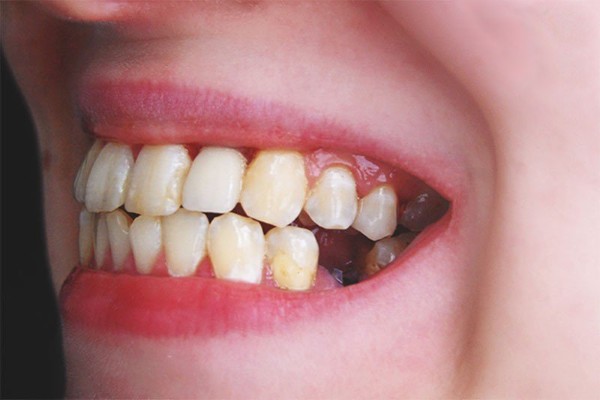 Mất răng do không điều trị kịp thời các bệnh về răng đúng cách 