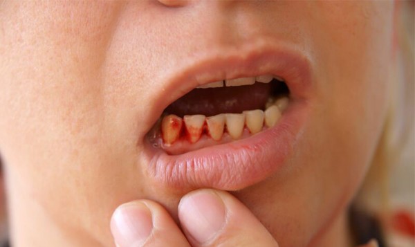 Dấu hiệu và mức độ chảy máu cần nhận biết sau khi nhổ răng