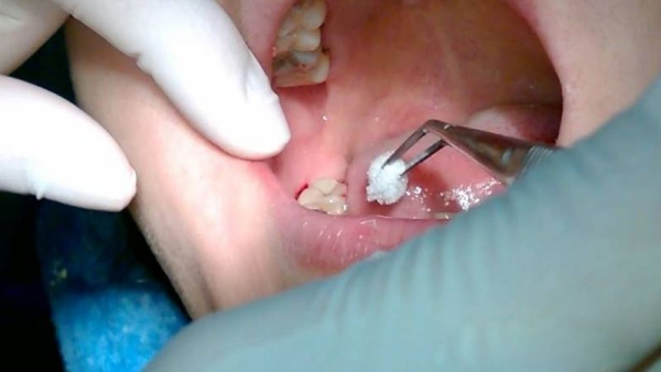 Cách cầm máu sau khi nhổ răng