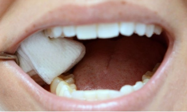 Các câu hỏi thường gặp liên quan đến cách cầm máu khi nhổ răng 