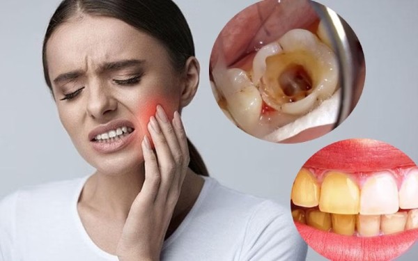 Răng bị ảnh hưởng do cách đánh răng không đúng cách