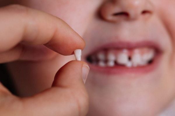 Hướng dẫn cách nhổ răng sâu tại nhà an toàn