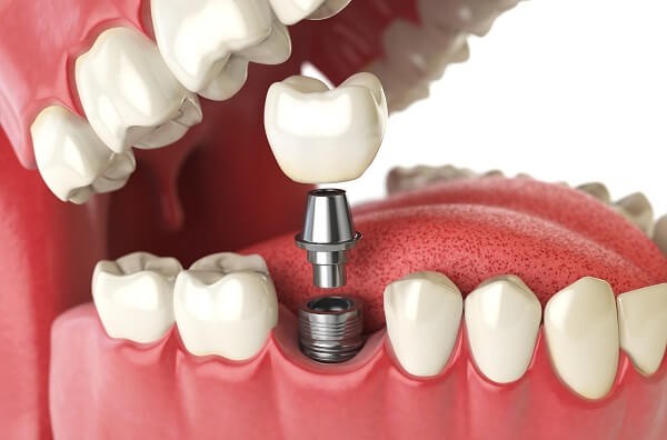 Cấy ghép implant là gì?