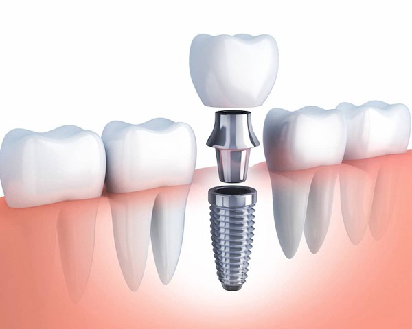 Các câu hỏi phổ biến về việc cắm implant có đau không