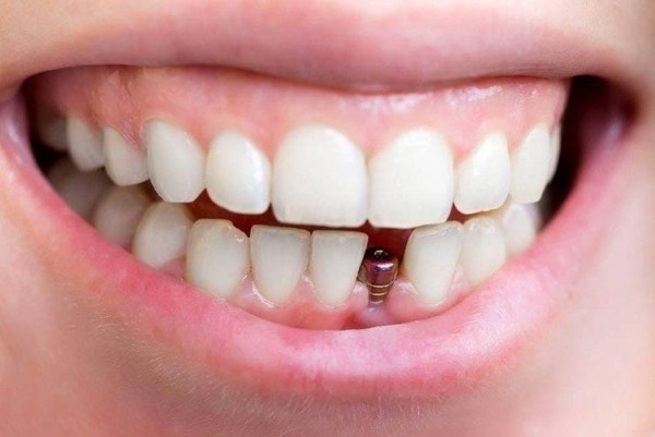 Thực tế cảm giác cắm implant có đau không? 