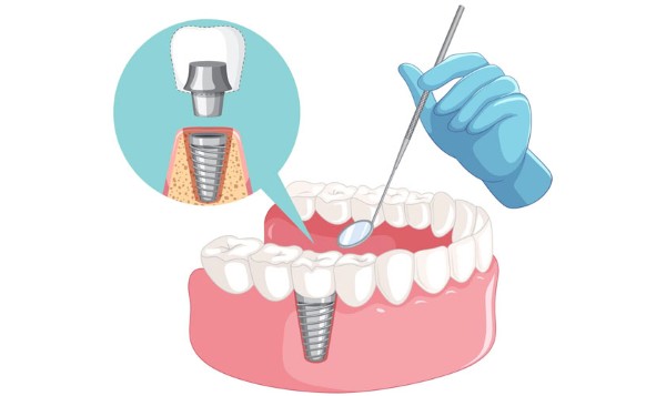 Các yếu tố ảnh hưởng đến mức độ đau khi cấy ghép implant