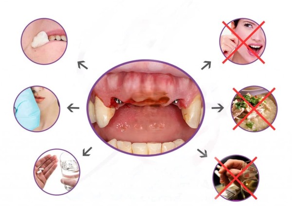 Bệnh nhân cần lưu ý chăm sóc đúng cách sau khi cấy ghép implant 