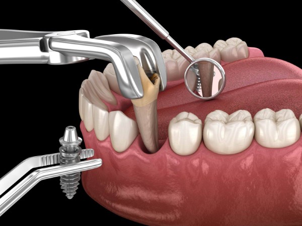 Các giai đoạn trong quy trình cắm implant có đau không? 