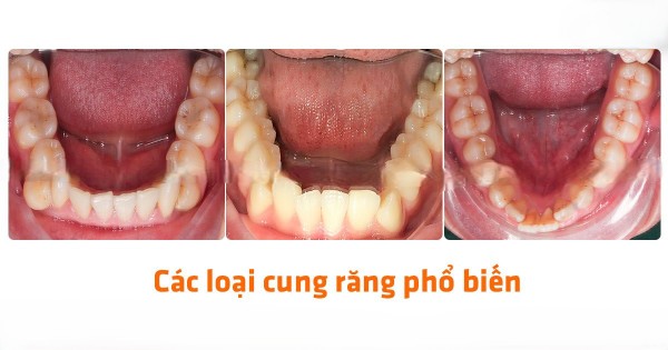 Cung răng có thể được phân loại thành nhiều dạng khác nhau