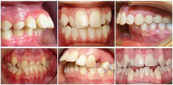 Các bất thường và sai lệch cung răng thường gặp