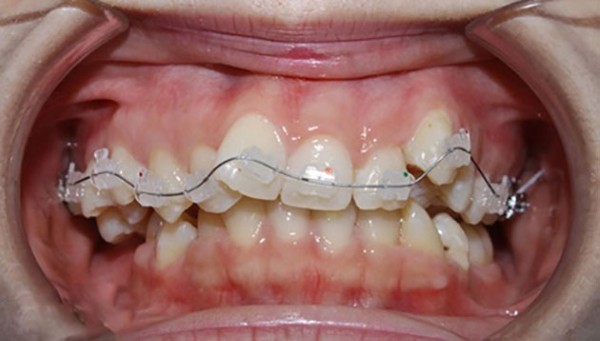 Ảnh hưởng của răng đến kế hoạch điều trị nha khoa