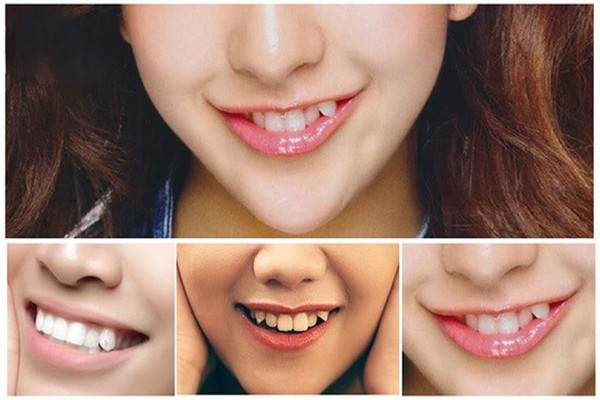 Răng khểnh là răng nanh mọc lệch hoặc nhô ra một cách nổi bật hơn các răng khác