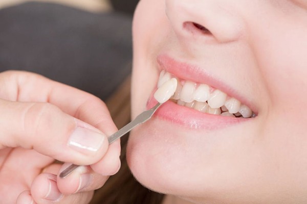 Đắp răng khểnh là một phương pháp thẩm mỹ nhằm tạo hình cho răng