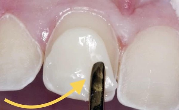 Phương pháp đắp răng khểnh bằng composite