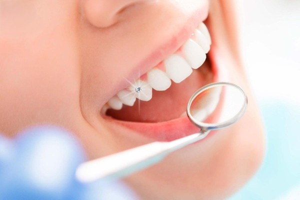 Quy trình đắp răng khểnh chuyên nghiệp tại nha khoa